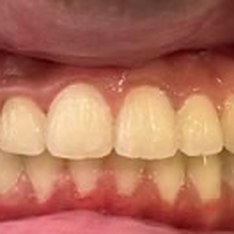 Smile after treatment at Misha Orthodontics