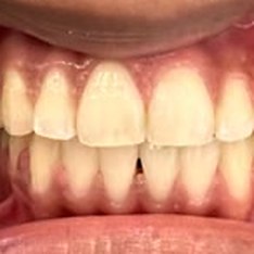Smile after treatment at Misha Orthodontics