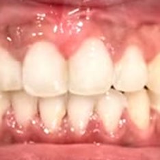 Smile after treatment at Misha Orthodontics