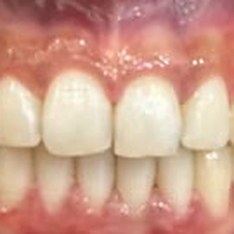 Smile after treatment at Misha Orthodontics