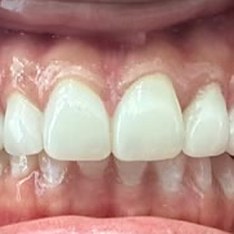 Smile after treatment at Misha Orthodontics
